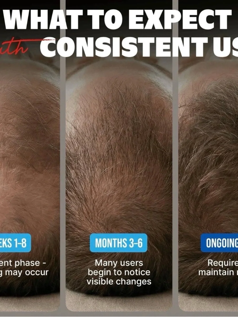 Kirkland Signature Minoxidil Topical Solution Hair regrowth treatment